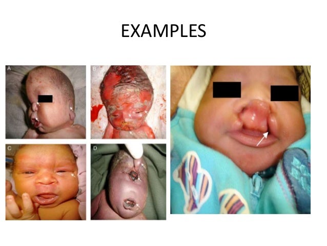 Jubei Chan Xxx Cranio Facial Anomalies